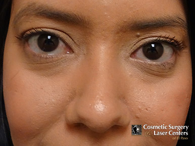 blepharoplasty_55_before-front