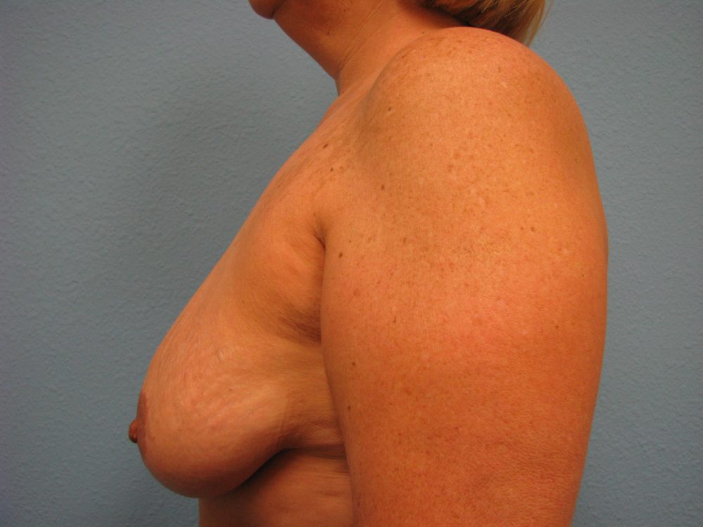 breast_lift_patient-82-before-left